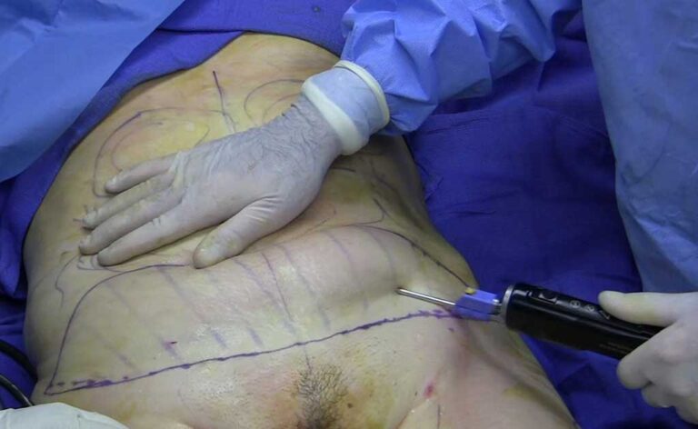 Fat-removal-using-cannula-during-tumescent-liposuction